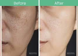 Pigmentation Peel